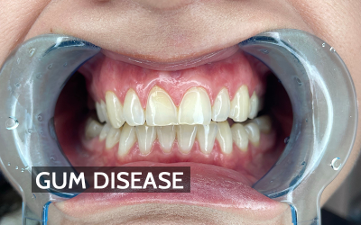 Pollution Beyond the Lungs: How Air Quality May Affect Gum Health